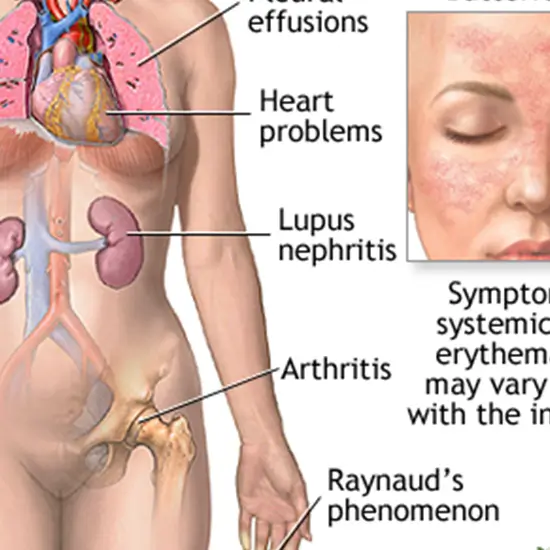 systemic lupus erythematosus panel